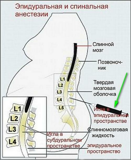 Схема эпидуральной анестезии