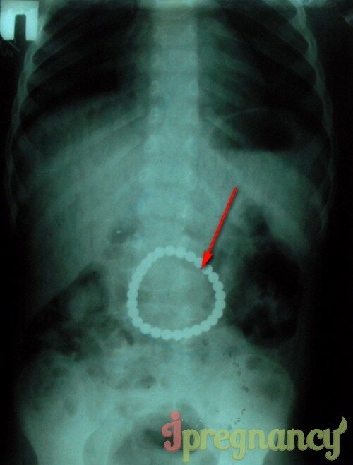 на рентгенограмме органов брюшной полости в желудке у ребенка отчетливо видны магниты из неокуба, склеившиеся в округлое ожерелье