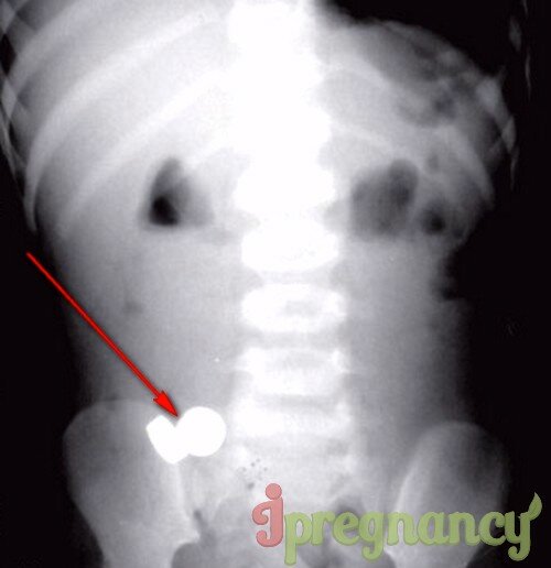 на рентгеновском снимке светлые пятна – это проглоченные «пальчиковые» батарейки в желудке