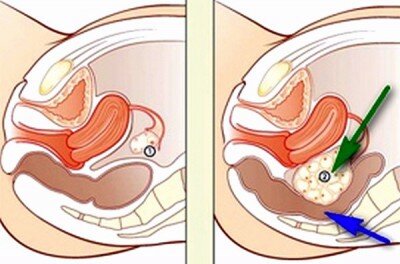Можно ли определить кисту яичника при гинекологическом осмотре thumbnail